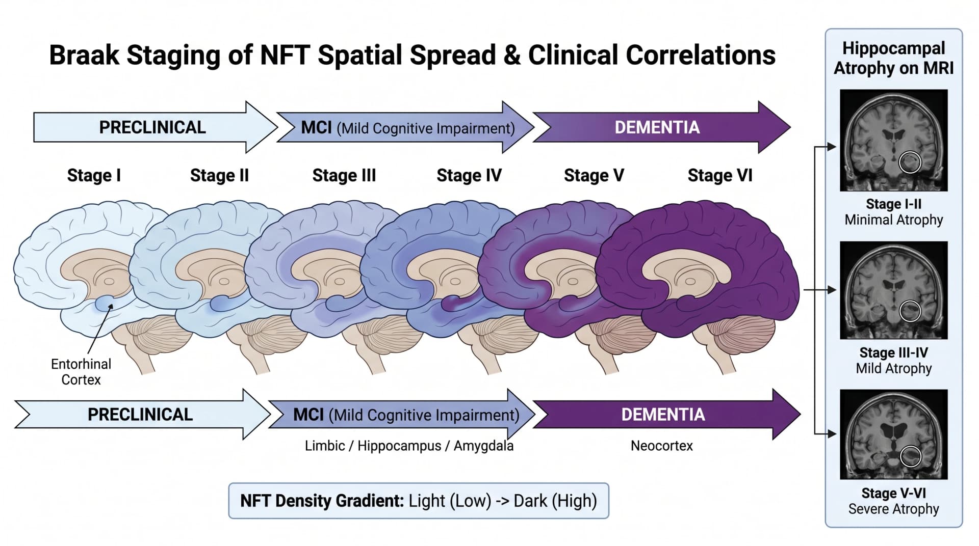 Braak staging 다이어그램: entorhinal cortex에서 hippocampus를 거쳐 neocortex까지 6단계에 걸친 NFT 확산, 임상 중증도와 상관 (SciFig로 생성한 이미지)