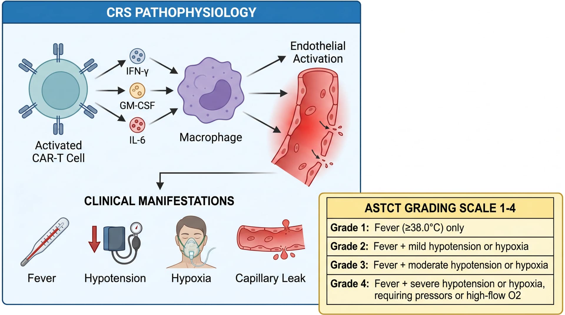 CRS pathophysiology: CAR-T releases IFN-γ and GM-CSF, IL-6 amplification, ASTCT grading 1-4 (Figure generated with SciFig)